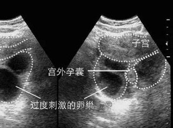 45岁做婴儿试管合适吗？45岁高龄做试管的全攻略！